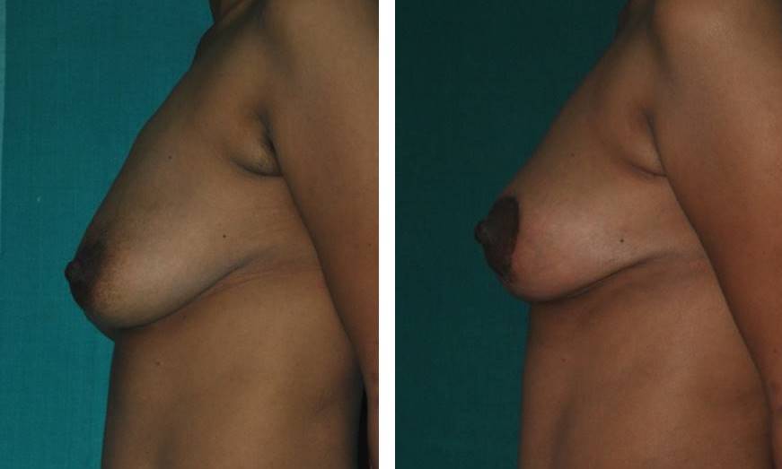 Breast lift surgery Kerala